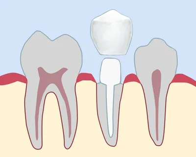 Вкладка на зуб CEREC вместо металлической вкладки, преимущества вкладки  Cerec