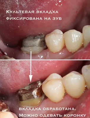 Зубная культевая вкладка под коронку в Феодосии, подготовка зуба к  установке коронки