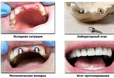 В каких случаях используется культевая вкладка