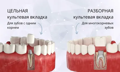 Восстановление зубов вкладками и коронками