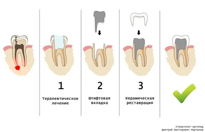 Культевая вкладка. Установка на передний и жевательный зуб в Москве и  области | НоваДент