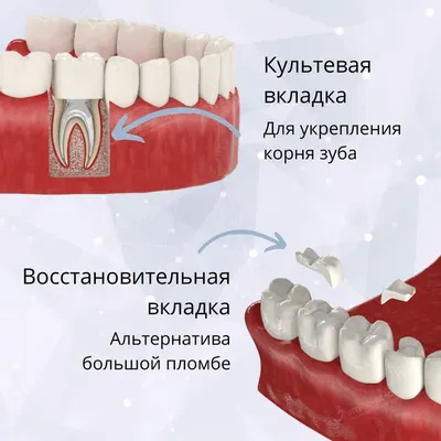 Культевая вкладка под коронку, цена изготовления и установки на зуб