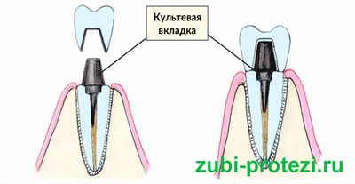 Штифтовые культевые вкладки — Мартынов Дмитрий Викторович