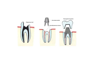 Культевая вкладка зуба - показания, противопоказания, виды, изготовление,  установка