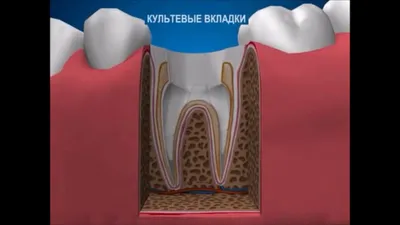 Культевые вкладки. Стоимость изготовления из металла, золота и керамики |  Стоматология Дентал Мир