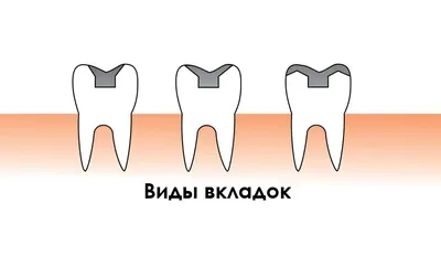 Что такое культевая вкладка? - Ортодонтическая клиника \"Альтер Эго\". Спб.