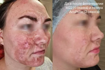 Удаление купероза на лице аппаратом М22 | Premium Aesthetics