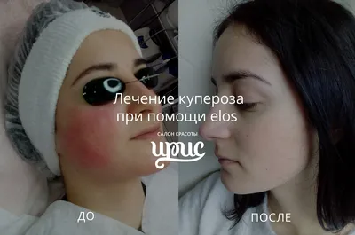 Удаление купероза на лице аппаратом М22 | Premium Aesthetics