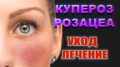 Купероз на лице — лечение купероза | Медицинский центр Эра