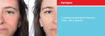 ЛЕЧЕНИЕ КУПЕРОЗА 🔥 Купероз — это стойкое расширение мелких капилляров с  утолщением и выраженным снижением эластических свойств их стенок, … |  Instagram