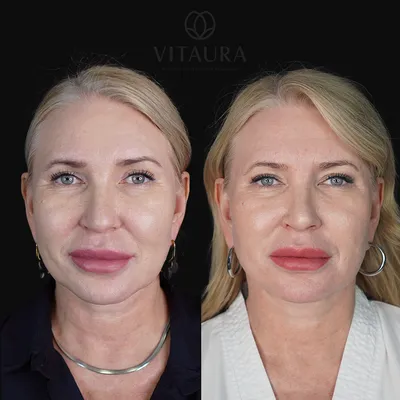 Фото до и после | Клиника аппаратной и инъекционной косметологии Vitaura