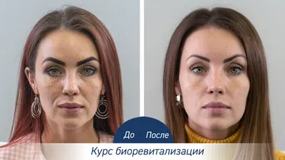 Биоревитализация в Иркутске ✨ | Гиалуроновая кислота для лица: цена на  процедуру в косметологическом центре