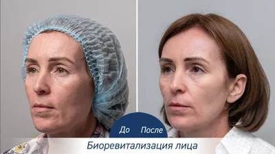 Результаты наших процедур До / После - Ева Клиник Краснодар