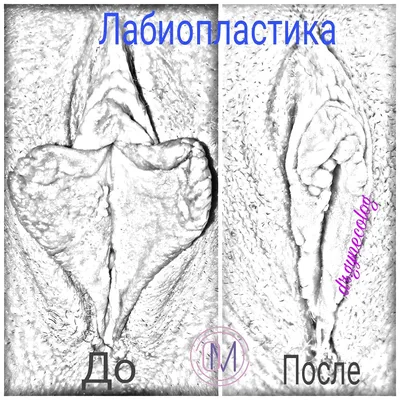 Лабиопластика (Пластика половых губ). Лабиопластика (операция по уменьшению  половых губ) проводится как по эстетическим показаниям, так и… | Instagram