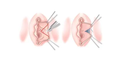 ROYAL MED - Лабиопластика - операция по изменению и уменьшению половых губ,  как малых, так и больших. После лабиопластики изменяется Восприятие себя,  восприятие мужем, улучшение отношений  •••••••••••••••••••••••••••••••••••••••••••••••••••••• Хирург ...