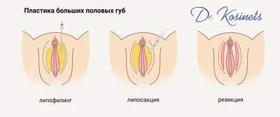 ▷Лабиопластика в Киеве – Интимна пластика половых губ ✓ Цены в МЦ ADONIS