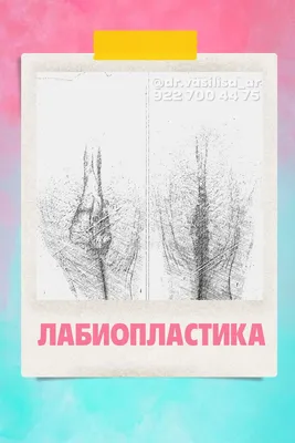 Передпухлинний центр \"Молекула\" - Пластика половых губ. Кому и зачем она  нужна? Лабиопластика заключается в хирургической коррекции наружных половых  органов, чаще всего из эстетических соображений Вам понадобится  лабиопластика если: ✓ изменен размер