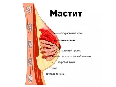 Лактостаз лечение консультация в медицинском центре ID-CLINIC  Санкт-Петербург