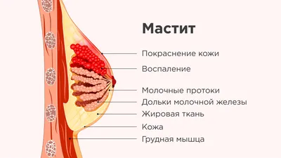 Замучил лактостаз». Как его победить?