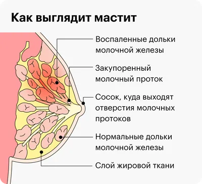 Лактостаз при грудном вскармливании: симптомы, лечение, массаж, отличия от  мастита