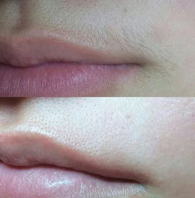 Лазерная эпиляция верхней губы фото до и после фотографии