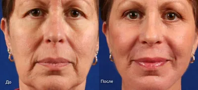 Фото до и после - Лазерная косметология - клиника Seline
