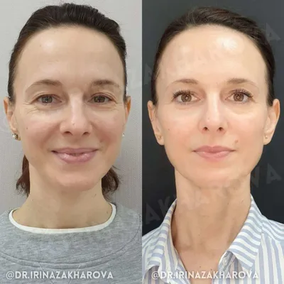 Лазерное удаление сосудов на лице (расширенных, сосудистых звездочек) по  доступной цене в Москве | Доктор Мезо