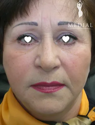 Комплексное омоложение лица и шеи + лазерная липосакция фото до и после.  Возраст пациента 62