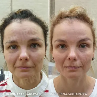 Лазерное удаление сосудов на лице (расширенных, сосудистых звездочек) по  доступной цене в Москве | Доктор Мезо