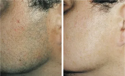 Фото до и после Лазерная эпиляция для мужчин — Сеть косметологических  клиник Эпилайк