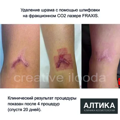 Лазерная шлифовка кожи лица: цена в Новосибирске