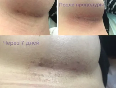 ᐅ Лазерное удаление шрамов в Киеве ᐊ Цены и отзывы на шлифовку шрама  лазером в клинике Аура