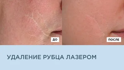 DR.BRAILOVSKI | Лазерная шлифовка рубцов на теле