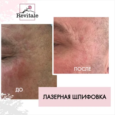 Лазерное удаление шрамов на теле в Киеве – Coolaser Clinic