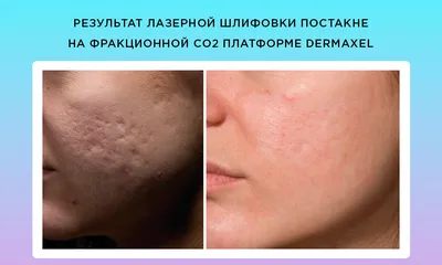 SMAS-лифтинг век: цены в Москве | СМАС-лифтинг вокруг глаз в клинике  BeautyWay Clinic