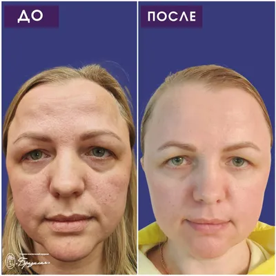 Лазерная шлифовка лица: нюансы до и после процедуры| Adonyss