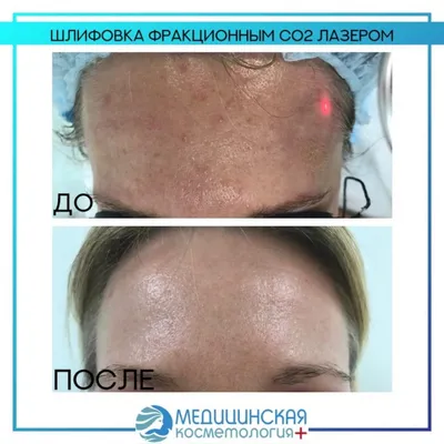 Лазерная шлифовка кожи UltraPulse дает эффект пластической операции без  скальпеля | Клиника косметологии PROFESSIONAL в Волгограде