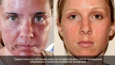 Лазерная шлифовка лица в Москве - цена, отзывы, фото до и после