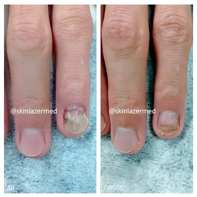 Лазерное лечение грибка ногтей фото до и после фотографии