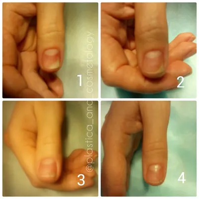 Лечение грибка ногтей в Минске - Linline