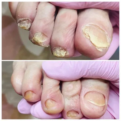 Лазерное лечение онихомикоза (грибка ногтей) - Академия пластической  хирургии и косметологии