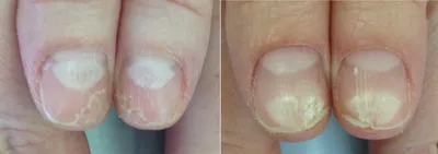 Лечение грибка ногтей лазером в Краснодаре | Центр эстетической медицины  \"Солнце\"