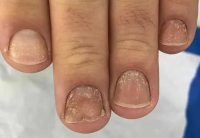 Лечение грибка ногтей лазером | Клиника АЛОДЕРМ Москва