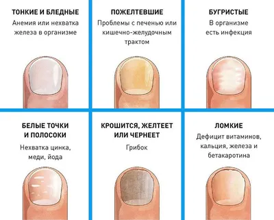 Лечение грибка ногтей с помощью лазера в Сумах - Verba Beauty