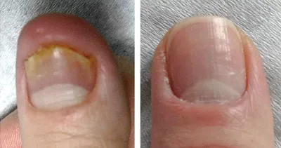 Лазерное лечение грибка ногтей в Киеве. Цены на лечение онихомикоза лазером.