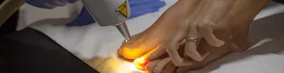 Лазерное лечение и удаление грибка ногтей в СПб цены