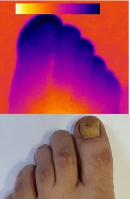 Лазерное лечение грибка ног и ногтей: стоимость лазерного лечения  онихомикоза и терапии в Москве