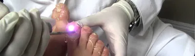 Лазерное лечение грибка ногтей в Гомеле | Цены в клинике Omnia Esthetic