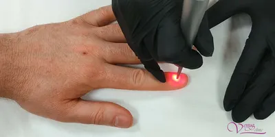 Лечение грибка ногтей - Центр Совершенство Мытищи