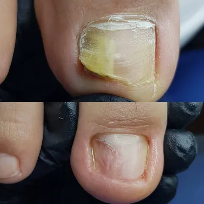 Смотрите, какая акция: лазерное лечение грибка ногтей со скидкой 50% от  клуба красоты \"Linline\"